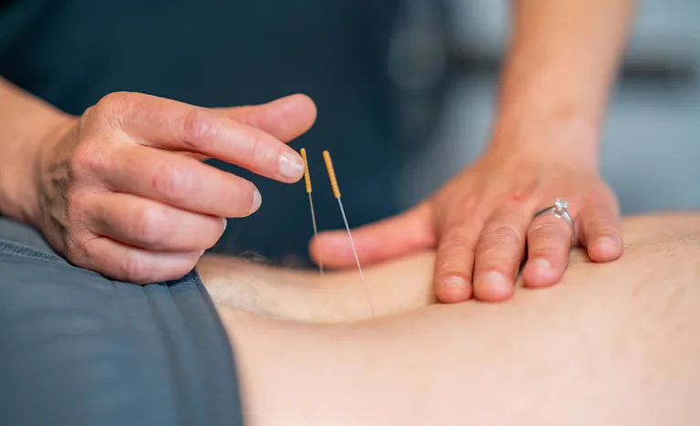 Dry-needling specialisatie bij Kine D'Hondt Dendermonde